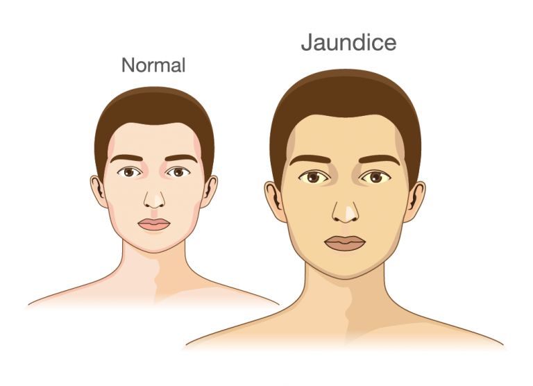 Jaundice Treatment in Nagpur
